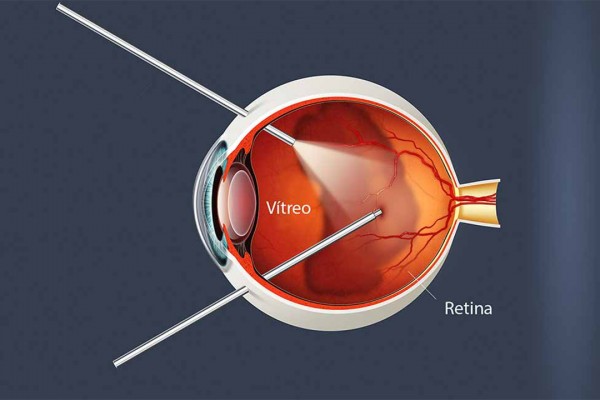 Cirurgias de Retina e Vítreo