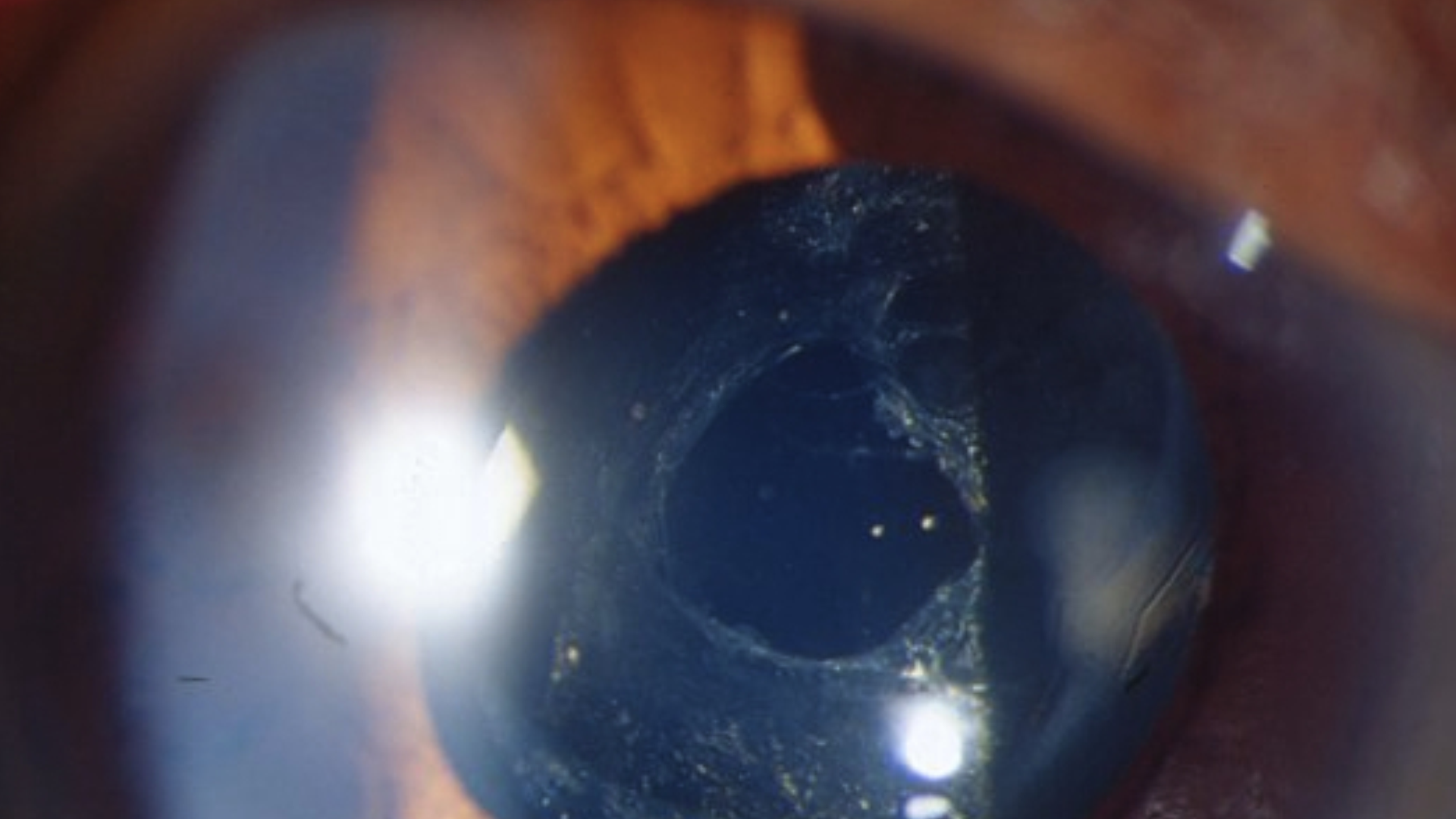 Capsulotomia a Laser