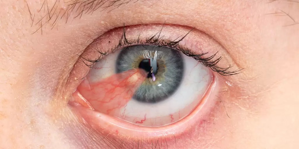 Cirurgia de Pterígio