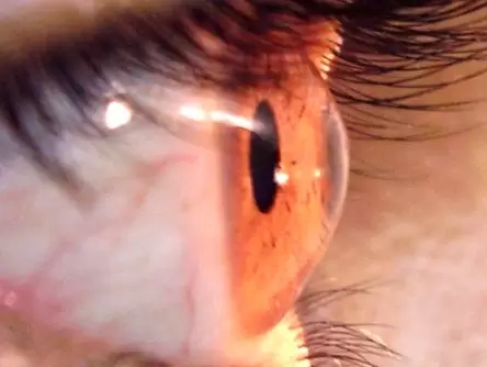 Cirurgia de Ceratocone – Crosslinking de Córnea